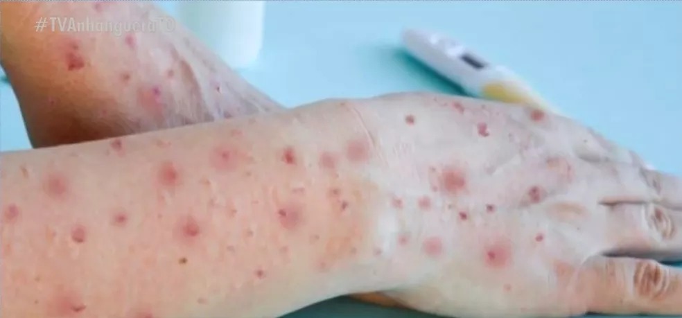 Treze casos de varíola dos macacos são confirmados na Bahia